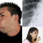 Bronchite aiguë : symptômes et traitements