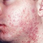 L’acné: symptômes et traitements